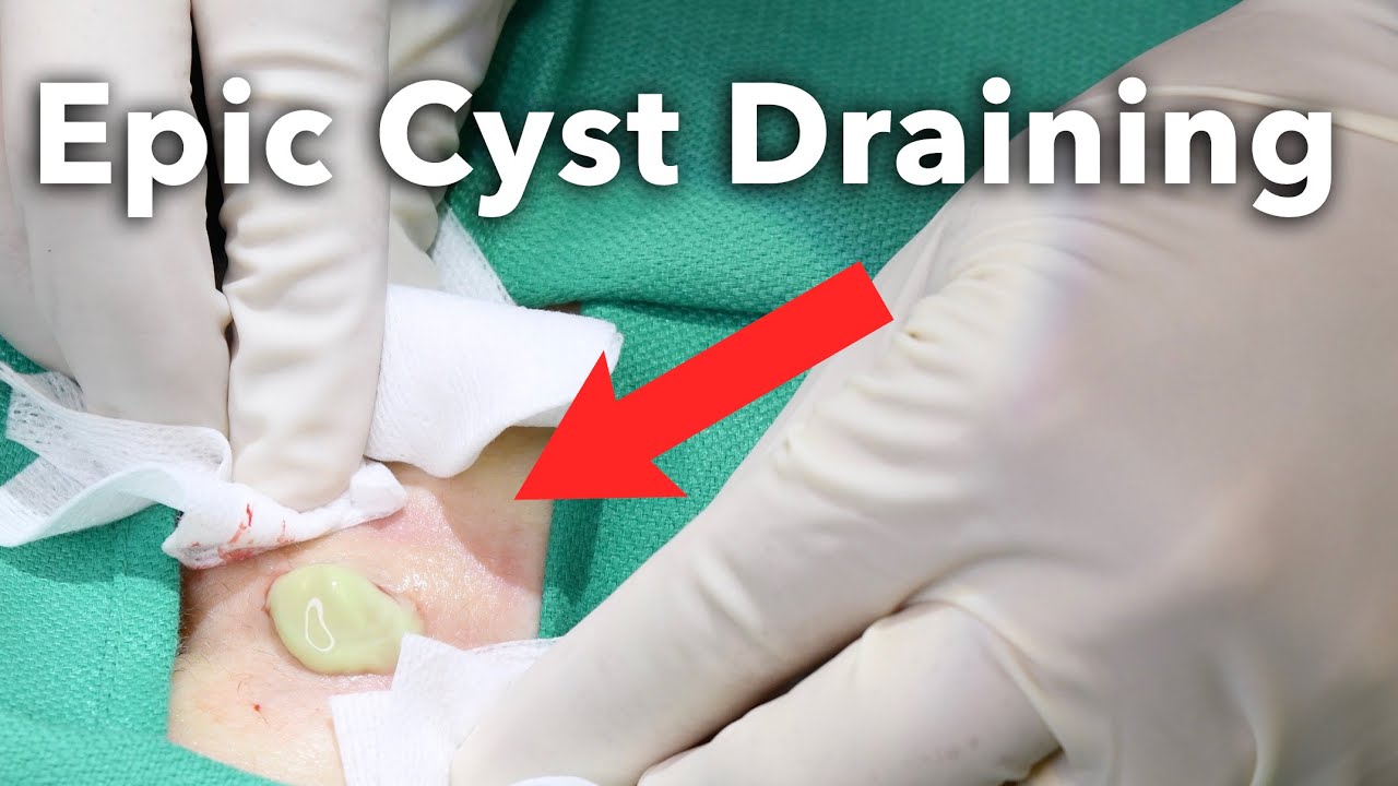 Managing A Pilonidal Cyst On The Gluteal Cleft Pimplepopping Tv