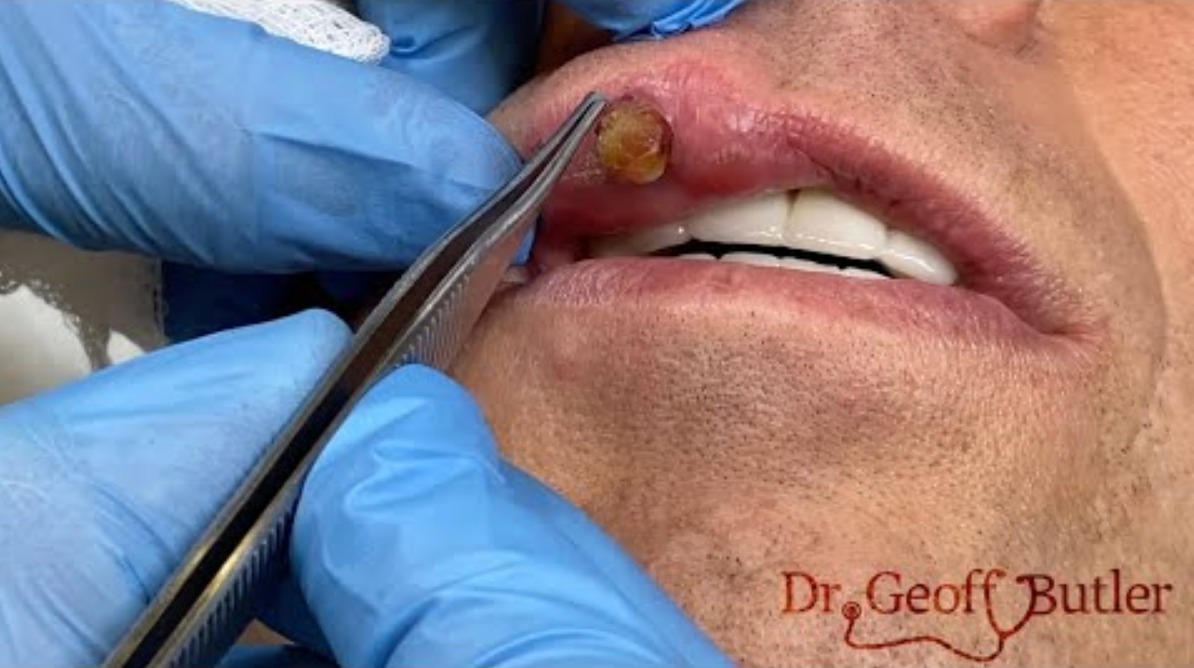 Pyogenic Granuloma Lip Removal Pimplepopping Tv