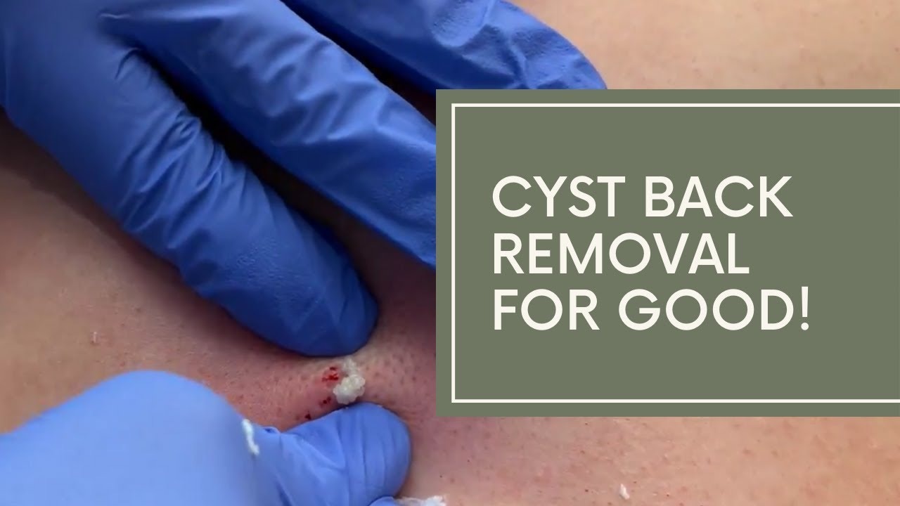 Back Cyst Removal - Pimplepopping.tv