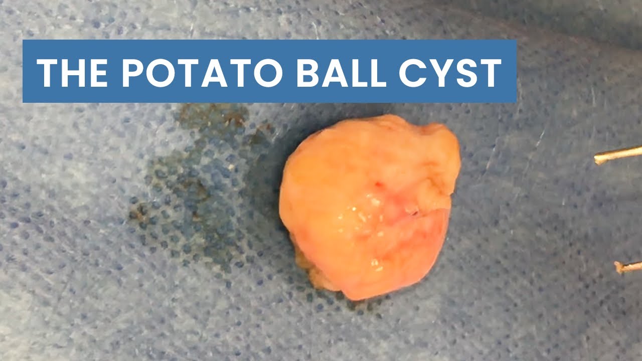 The "Potato Ball" Cyst (Whole Sac Removed) Pimplepopping.tv