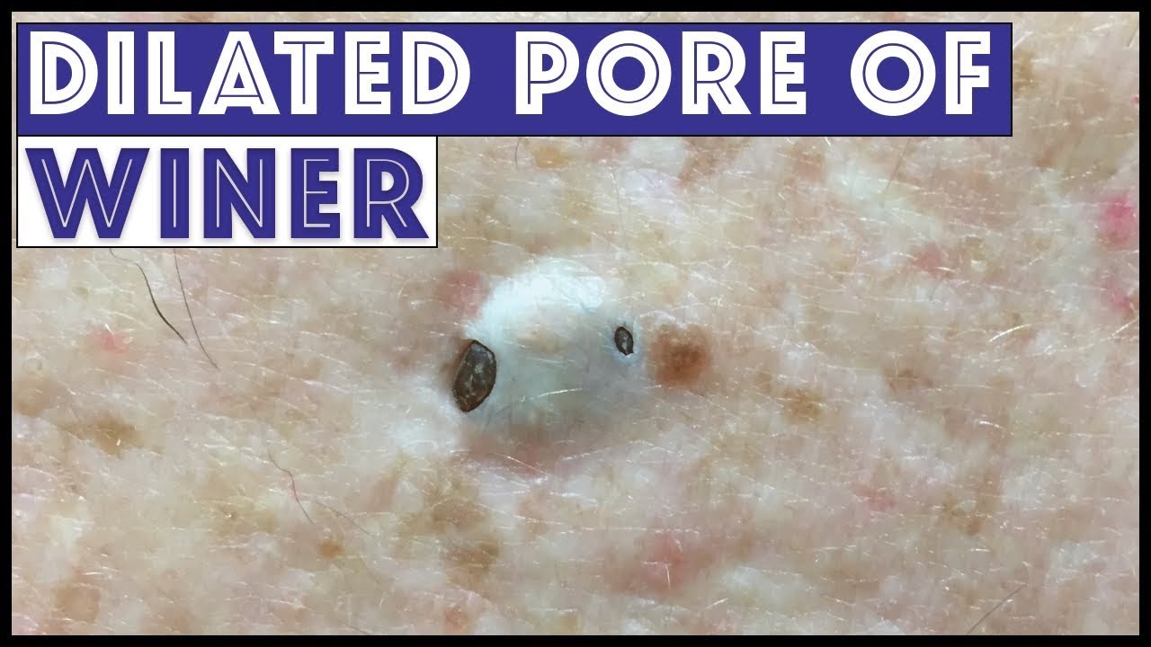 Dilated Pore Of Winer Giant Blackhead Satisfying Extractio Pimplepoppingtv 