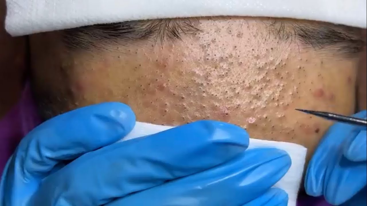 Extreme Blackhead Removal Pimplepopping.tv