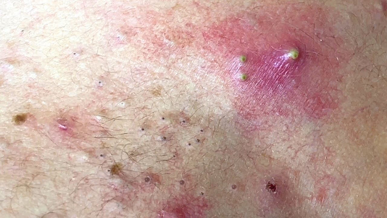 Large Acne Pimples Removal - Pimplepopping.tv