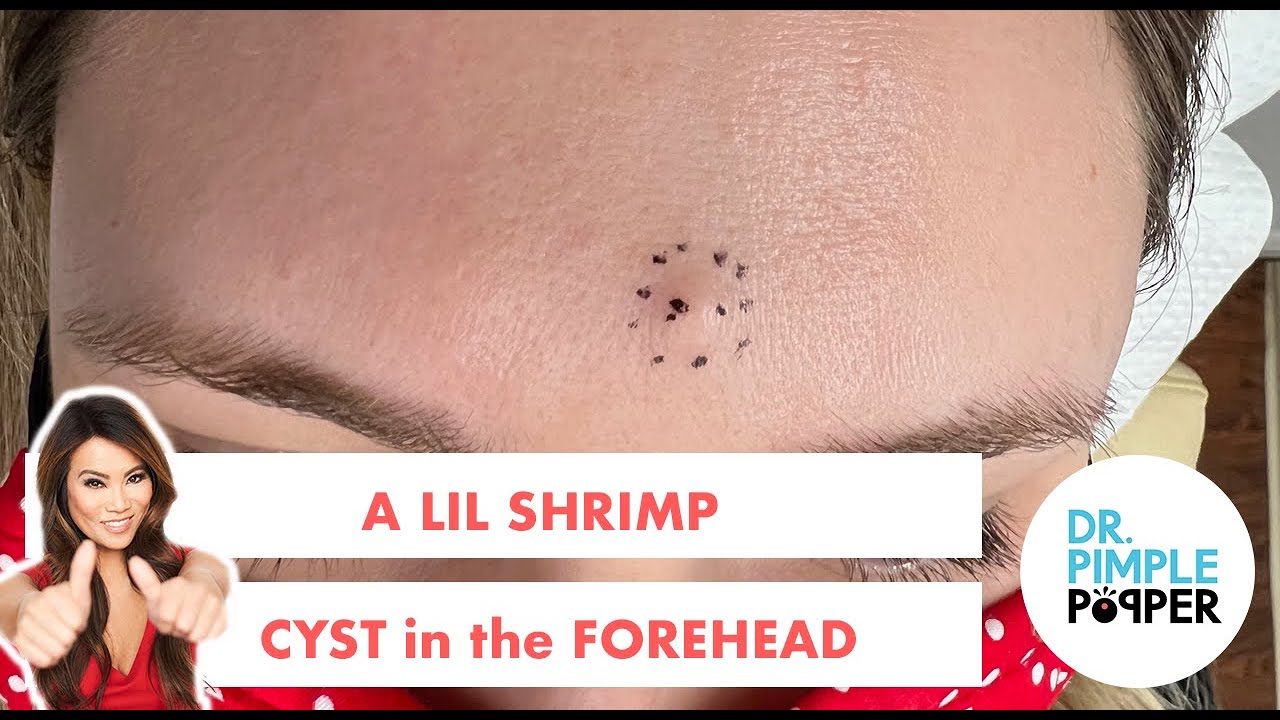 A Lil Shrimp Cyst in the Forehead - Pimplepopping.tv